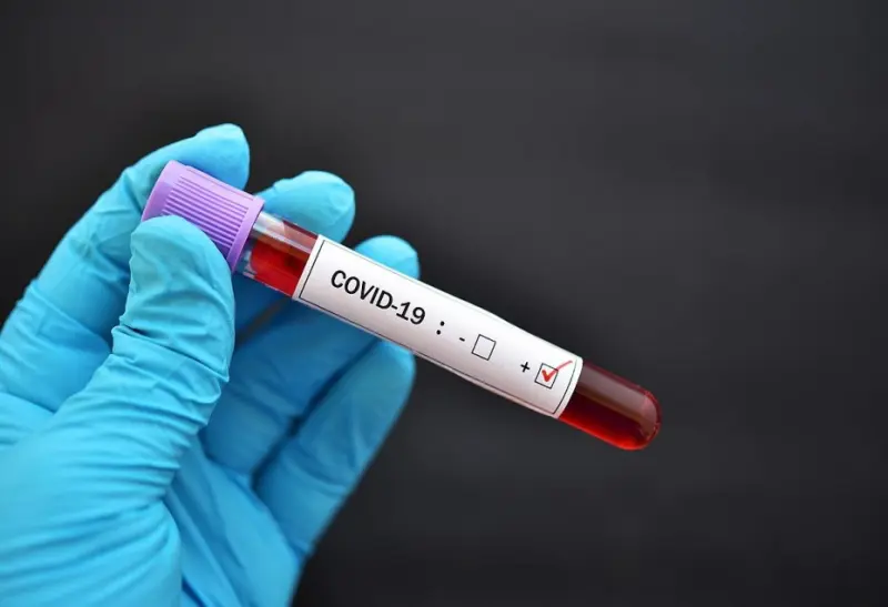 287 новых случаев COVID-19 из 2550 исследований выявили в Якутии