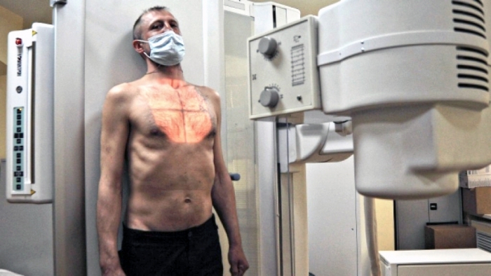 В Якутии троих граждан принудили лечиться от туберкулёза