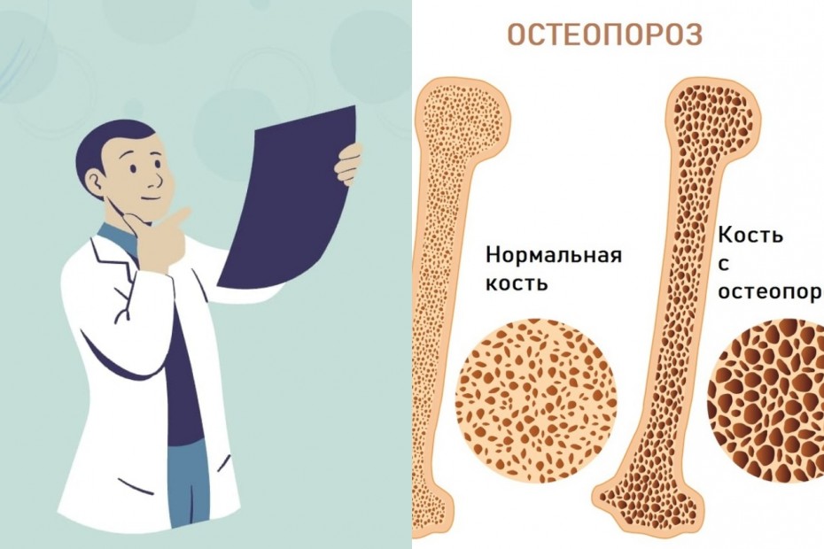 Остеопороз – это проблема всего мира