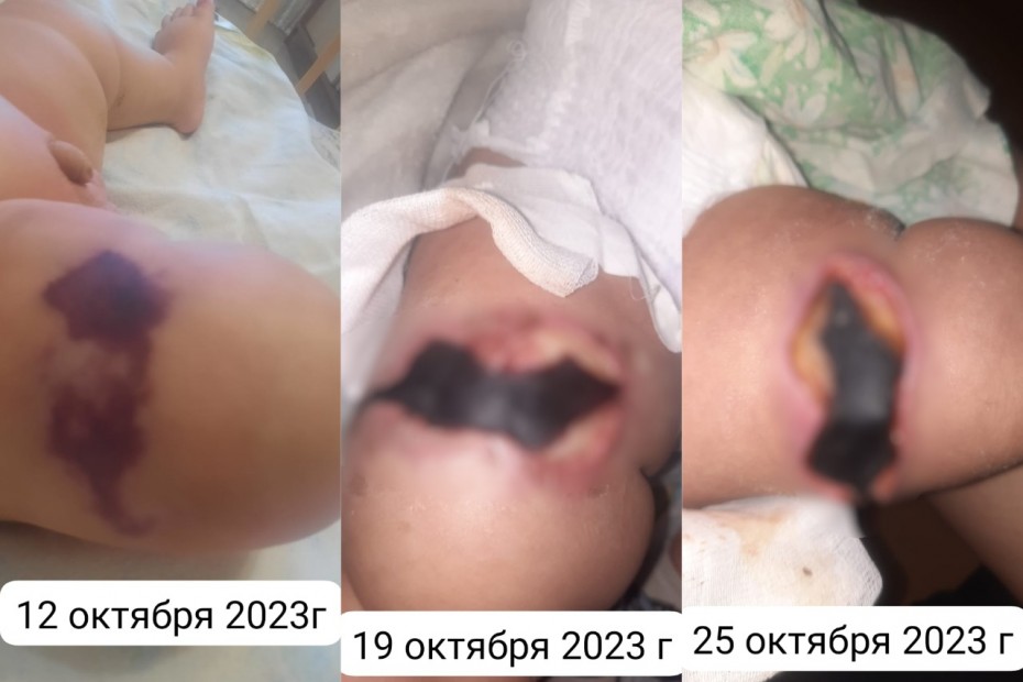 Случай с омертвлением участка кожи у младенца после прививки расследует Минздрав Якутии